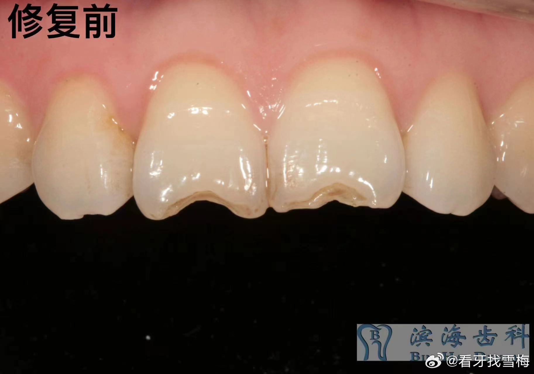最新牙齒修復(fù)技術(shù)，重塑一口新牙的神奇之旅