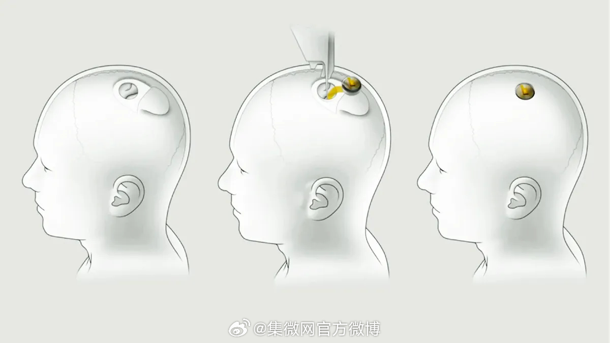 腦控芯片最新取出技術(shù)，心靈與自然的奇妙之旅